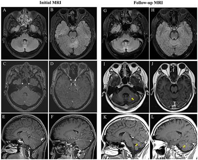 Case report and literature analysis: Autoimmune cerebellar ataxia associated with homer-3 antibodies